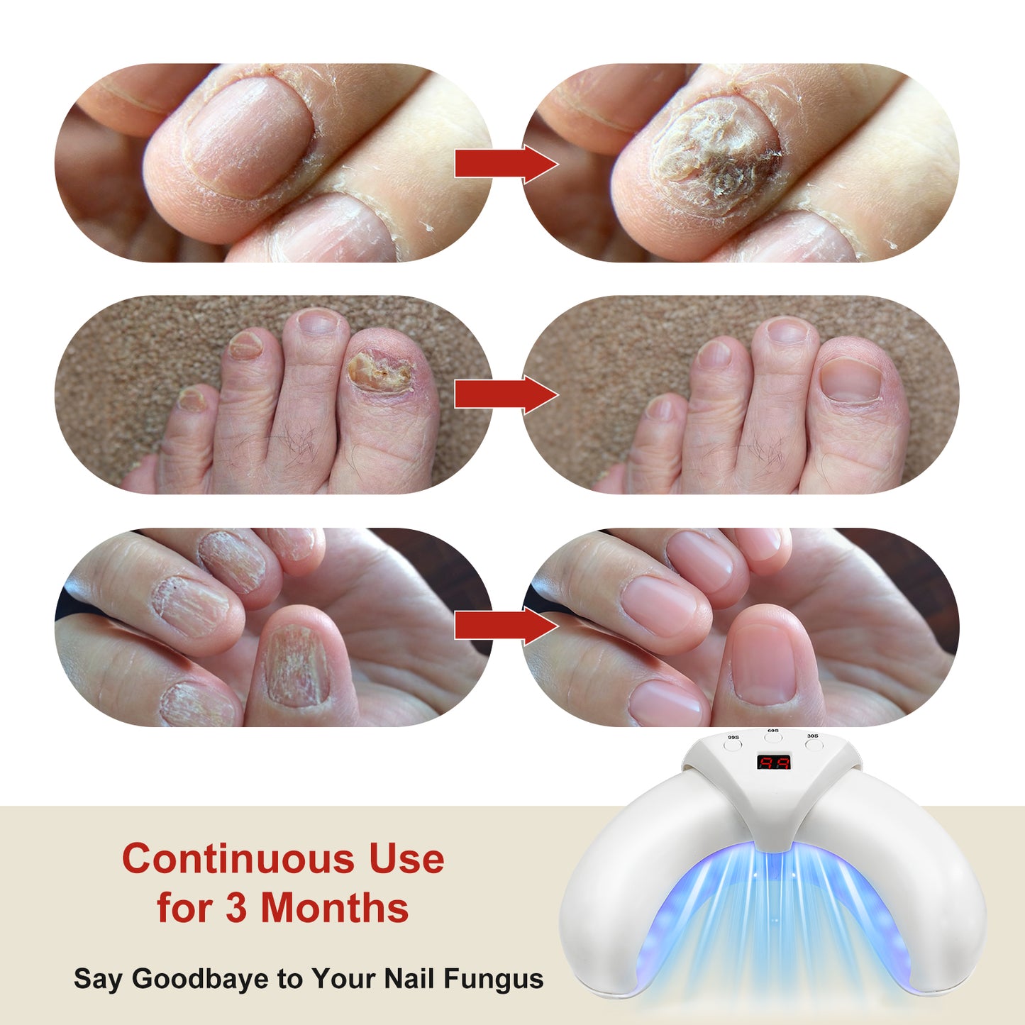 45W 905nm 22-LED Foldable Nail Phototherapy Device