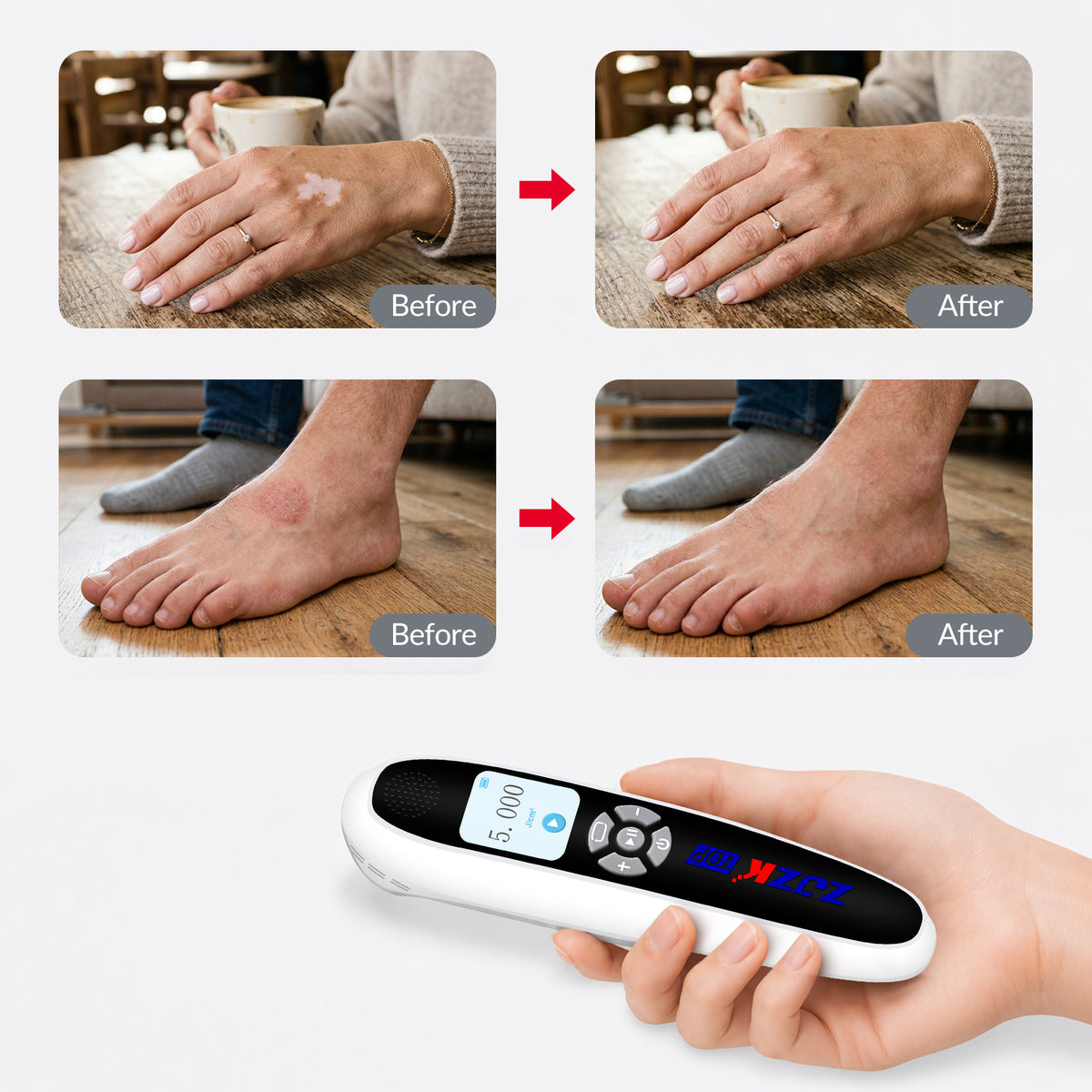 ZJZKTOP 308nm Excimer UVB Light Therapy Device, Handheld Targeted Phototherapy Lamp for Vitiligo, Psoriasis & Eczema, Rechargeable Portable Home Skin Treatment