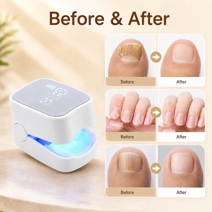 940nm + 500nm Dual-Wavelength Nail Fungus Care Device