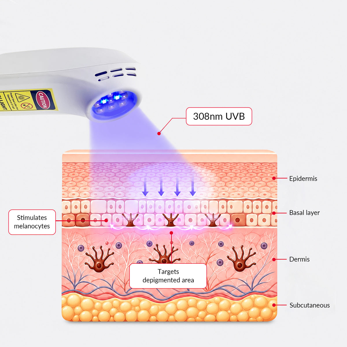 ZJZKTOP 308nm Excimer UVB Light Therapy Device, Handheld Targeted Phototherapy Lamp for Vitiligo, Psoriasis & Eczema, Rechargeable Portable Home Skin Treatment