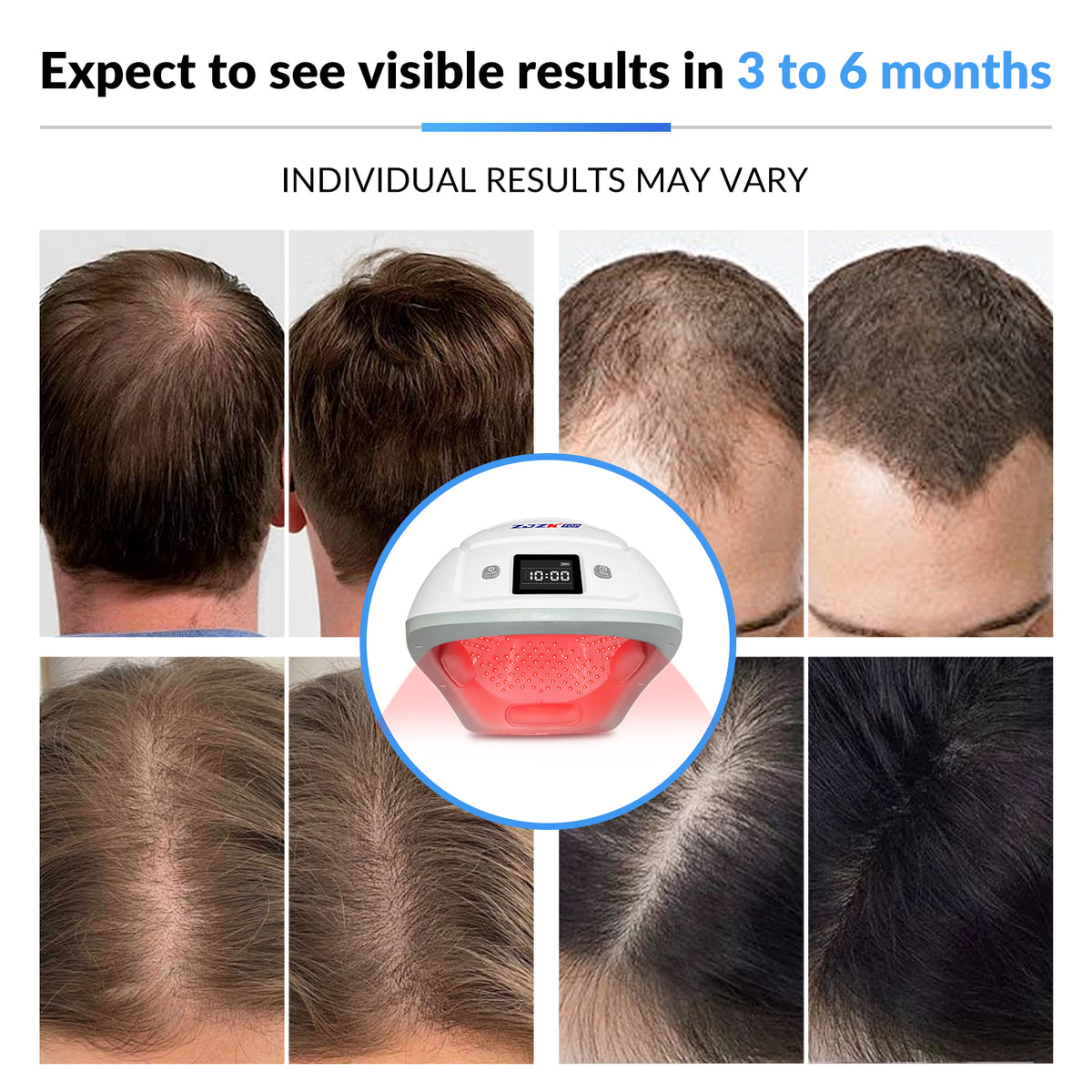 ZJZKTOP 650nm LLLT Laser Hair Growth Helmet, Rechargeable Hands-Free Therapy Cap for Thinning Hair, Volume Boost & Receding Hairline Treatment