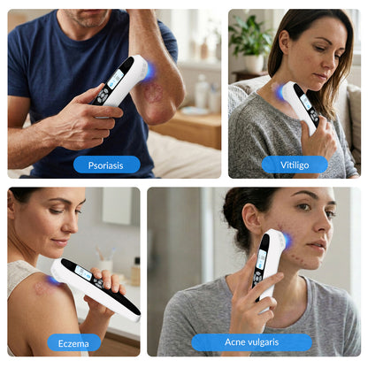 ZJZKTOP Portable 308nm UVB Phototherapy Device | Targeted Handheld Light for Home Use